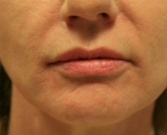 Feel Beautiful - Filler Gel for Smile Lines Around Lips - After Photo